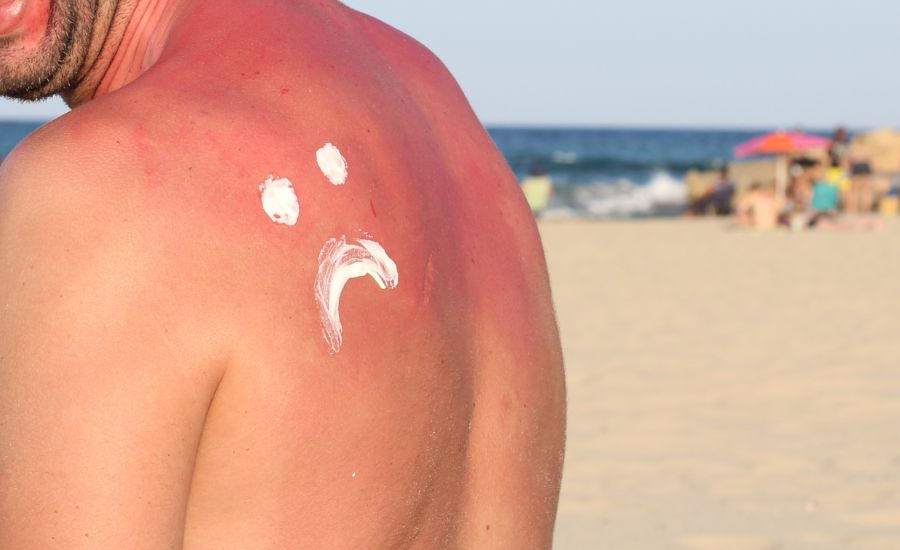 Saunieren mit Sonnenbrand auf der Haut